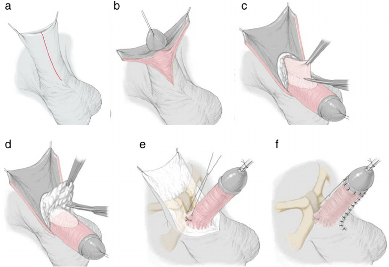 ligamentotomy to enlarge the penis