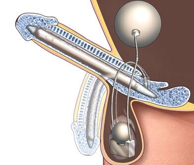 penis prosthesis to enlarge it