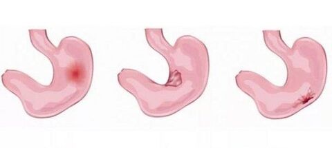 Stomach problems as a contraindication to enlarging the penis with soft drinks.